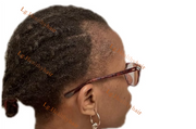 ALOPECIA: PRACTICAL SOLUTIONS/TIPS TO A REAL ISSUE