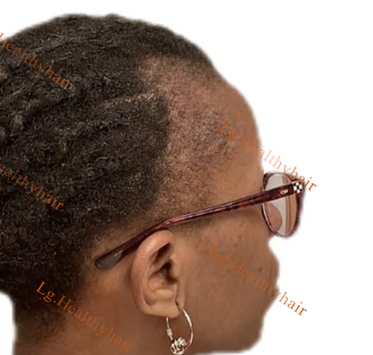 ALOPECIA: PRACTICAL SOLUTIONS/TIPS TO A REAL ISSUE